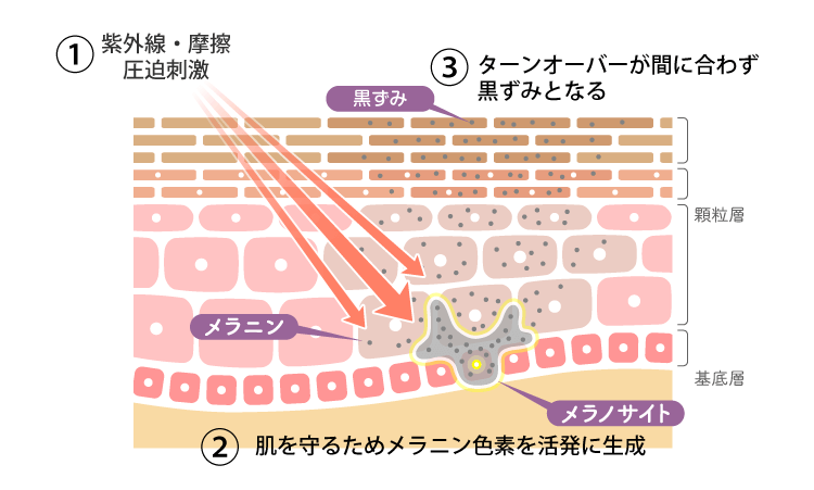 黒ずみの原因は摩擦とターンオーバーの乱れ