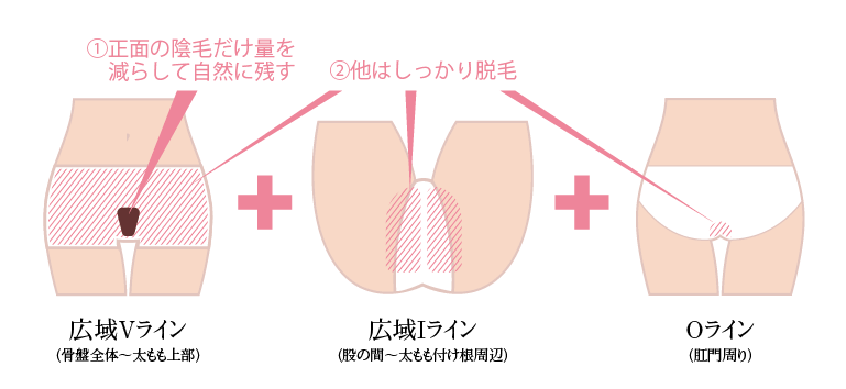 Vラインだけ小さく自然に残してIOラインはツルツルの無毛状態にする