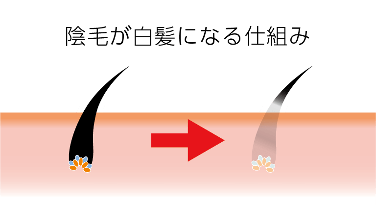 陰毛 アンダーヘア に白髪が その原因と解消方法 Vio脱毛専門サロン プリート
