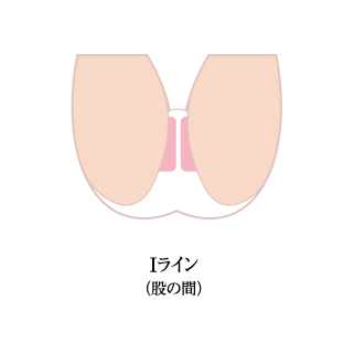 Iライン脱毛の範囲